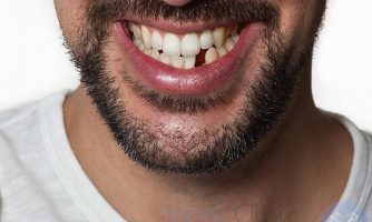 از دست دادن دندان ها، خطر ابتلا به زوال عقل و آلزایمر را افزایش می دهد